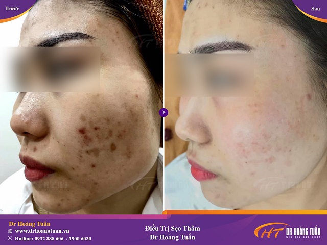 trị thâm bằng laser có hiệu quả không